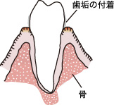 歯肉炎