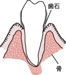 初期歯周病