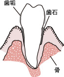 中等度歯周病