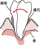 重度歯周病