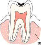 痛みを感じなくても、むし歯は始まっています