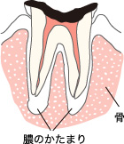 痛みはなくなりますが、治療は大変です